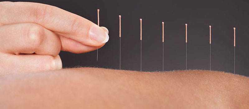 Medical Acupuncture